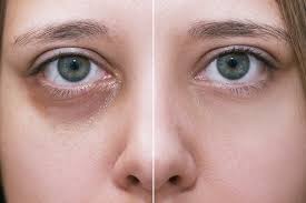 dark under eyes treatment